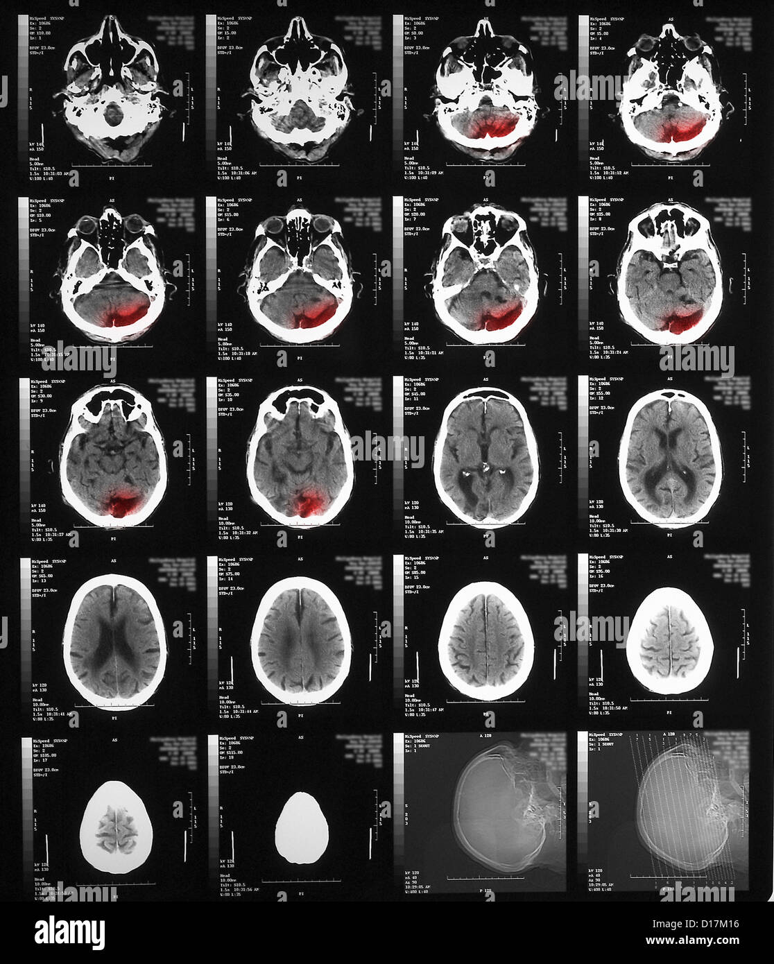 CT-Scan des älteren Menschen mit alten okzipitalen Infarkt Stockfoto