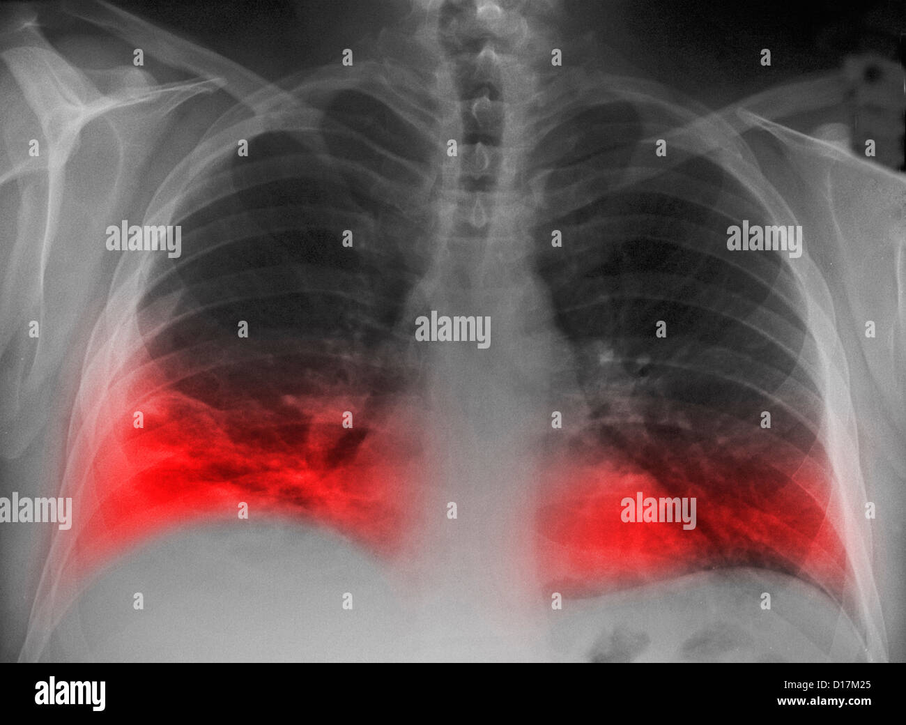 CXR Rauchers mit Infiltrat an einer Lungenentzündung in Lunge Stockfoto