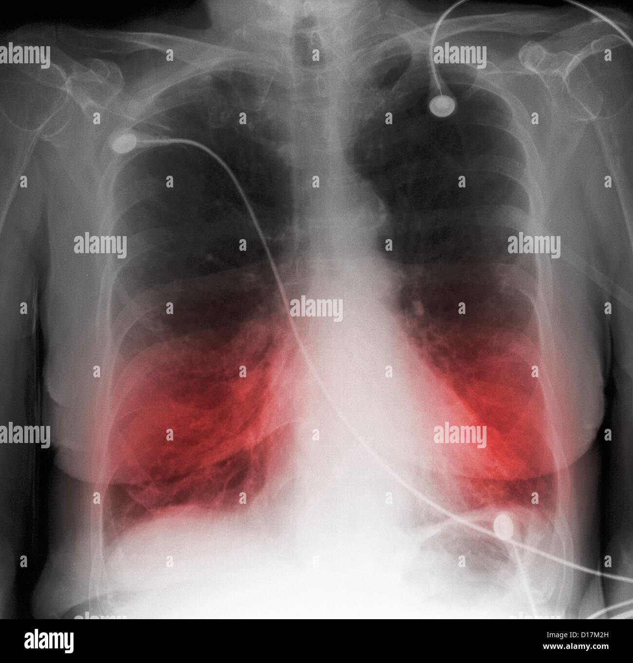 CXR ältere Raucher mit COPD Stockfoto