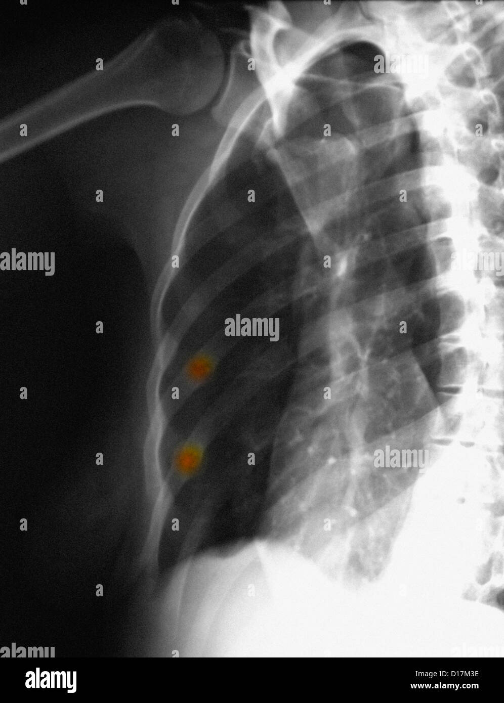 Röntgenuntersuchung der Brust mit geheilten Rippenfrakturen Stockfoto