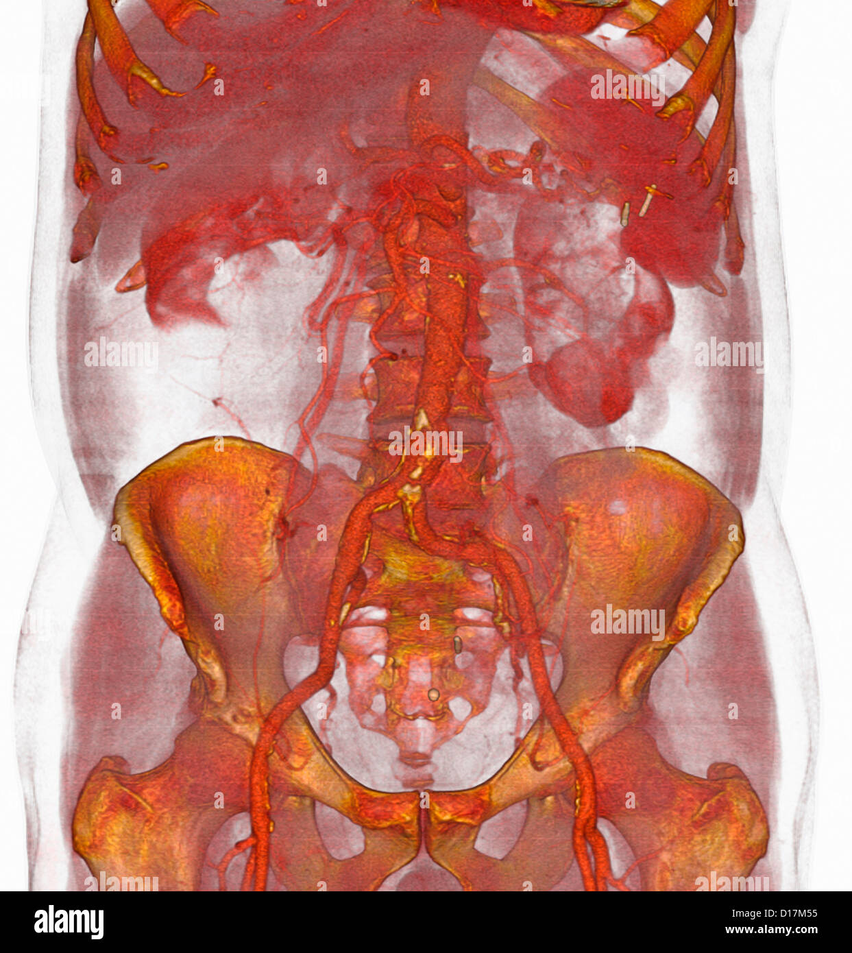 3D CT-Scan von atherosklerotischen Plaque, untere aorta Stockfoto