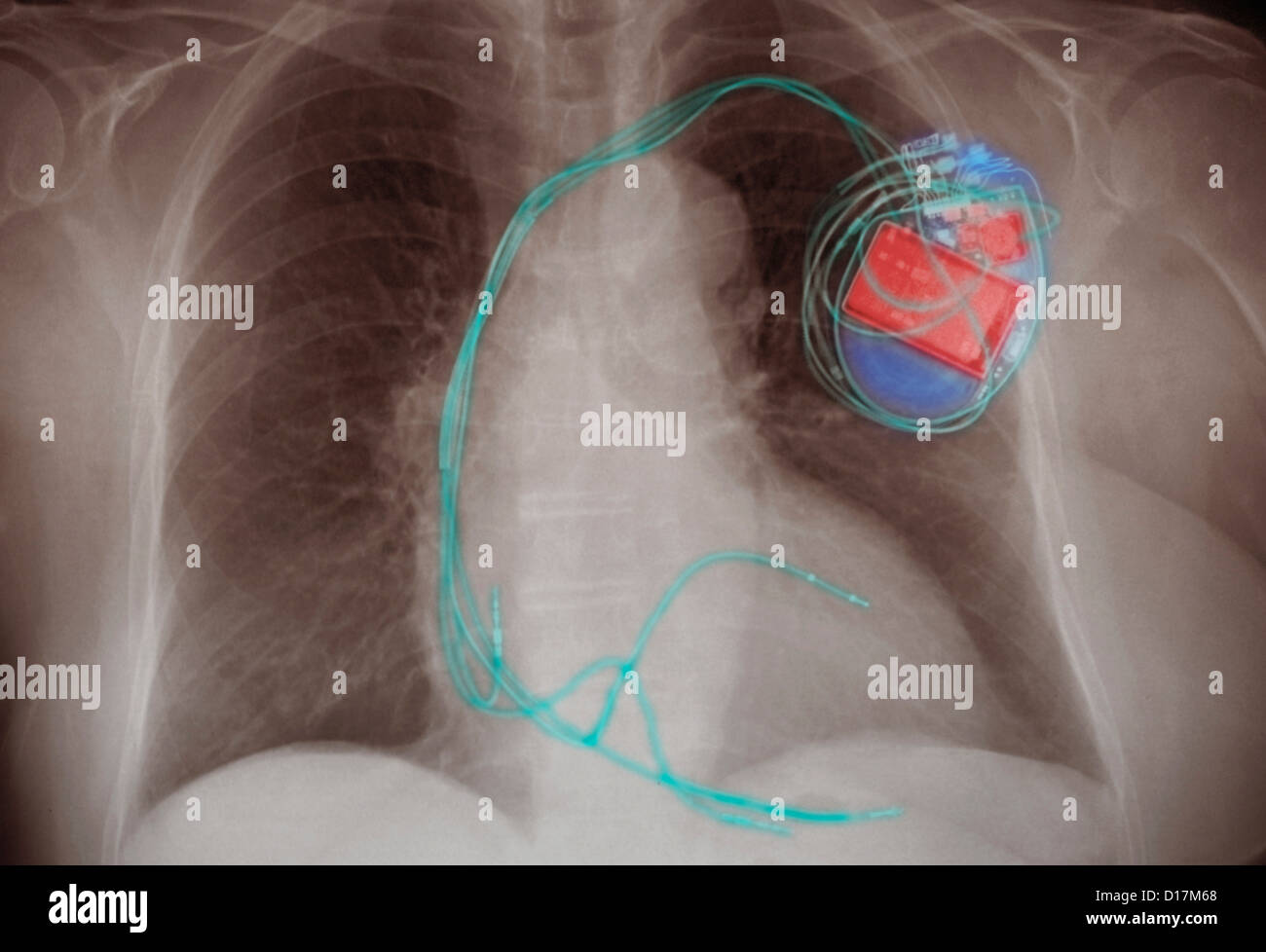 Röntgen-Thorax zeigt eine implantierte Herzschrittmacher Stockfoto