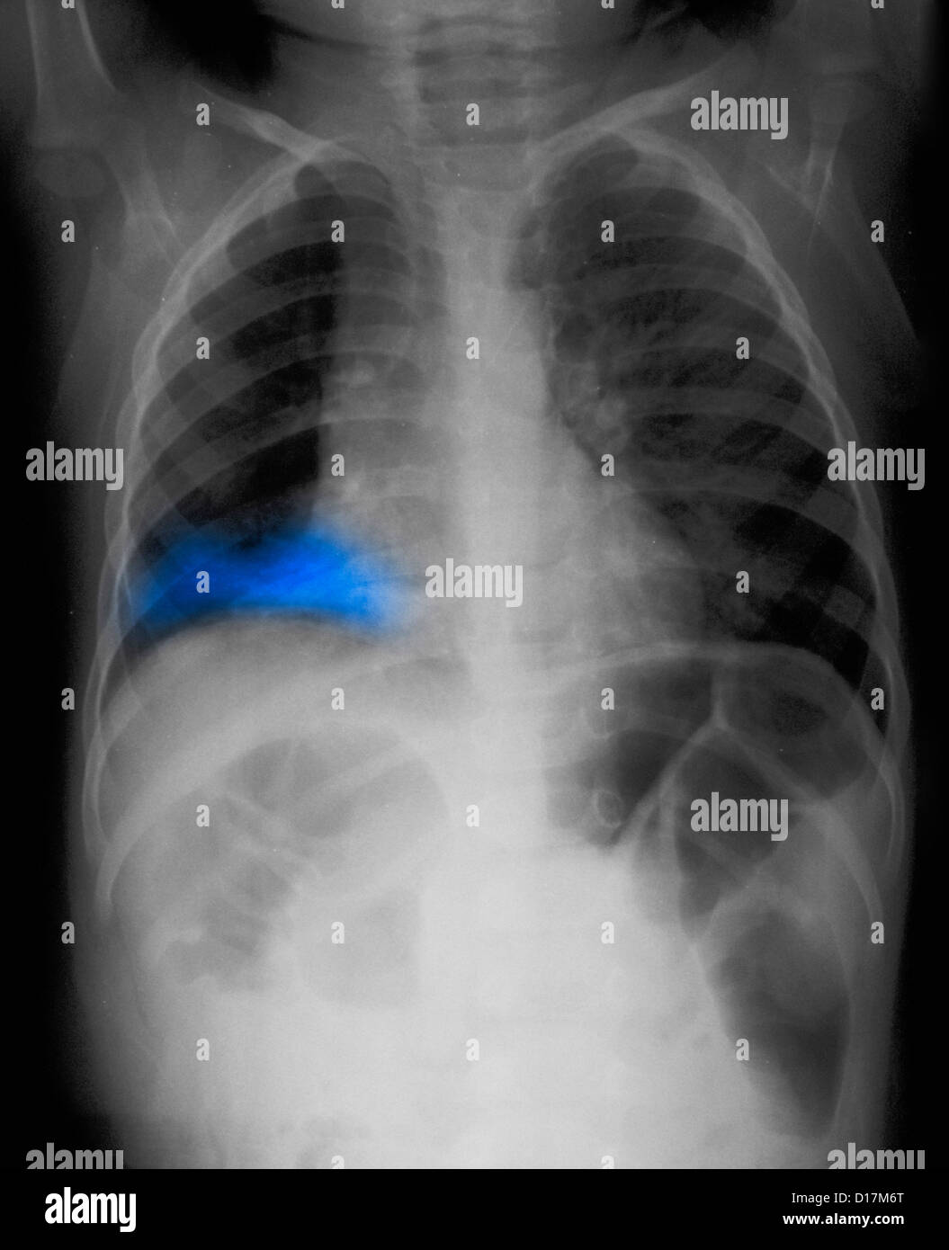 CXR eines Kleinkindes mit einer Lungenentzündung in der rechten Lunge Stockfoto