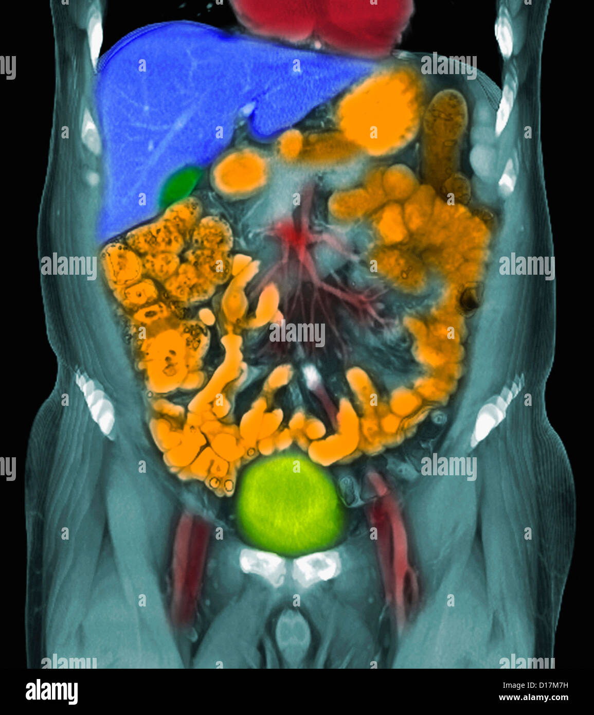 CT-Scan von Metastasen des Prostatakarzinoms Stockfoto
