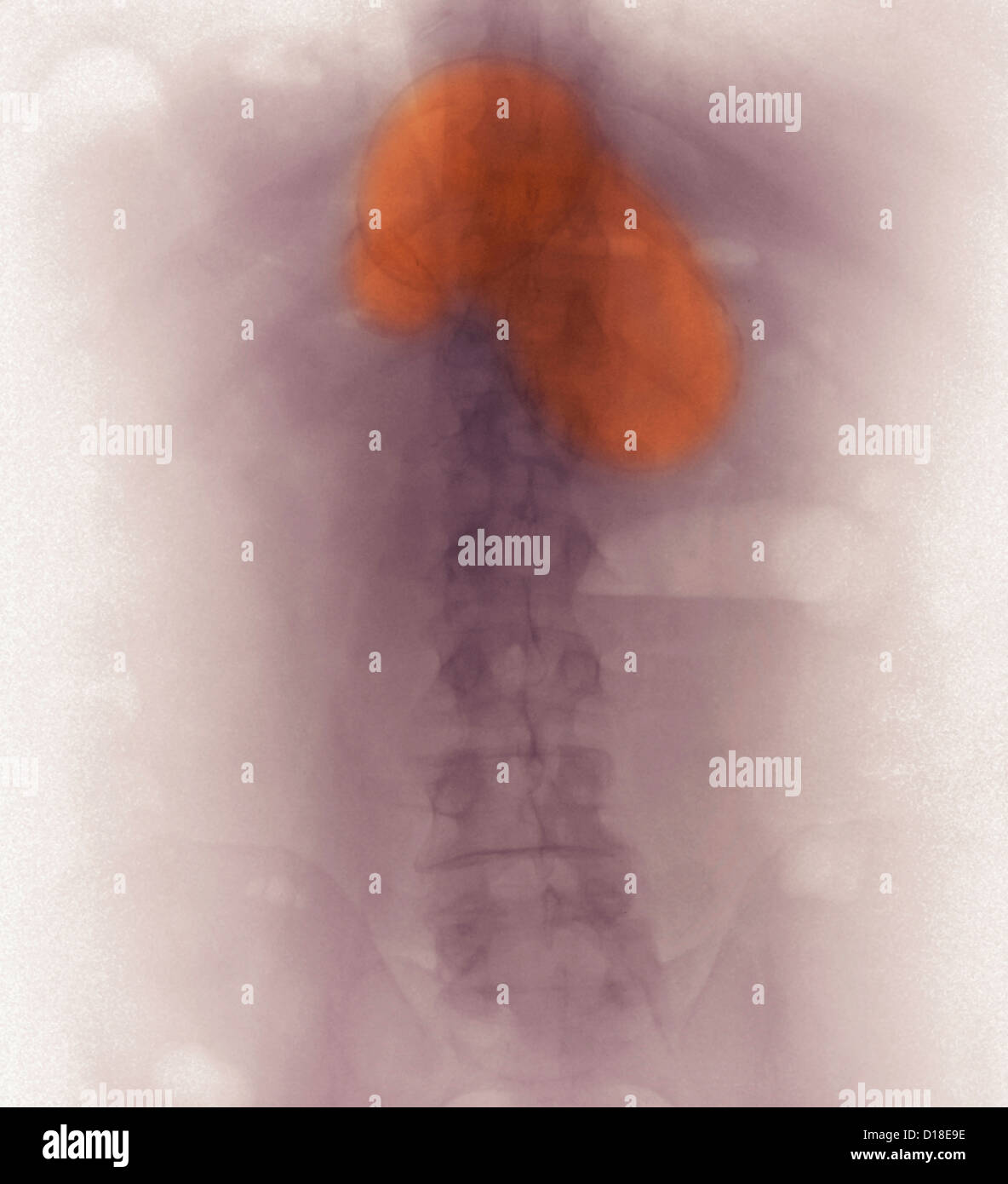 Pankreas Pseudozyste auf AbdominalRöntgenstrahl gesehen