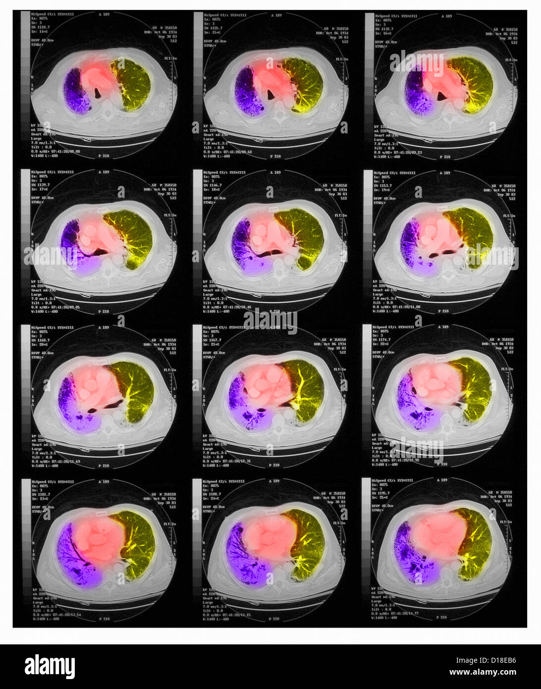 Brust CT-Scan, kleinzelliges Karzinom, Lungenentzündung Stockfoto