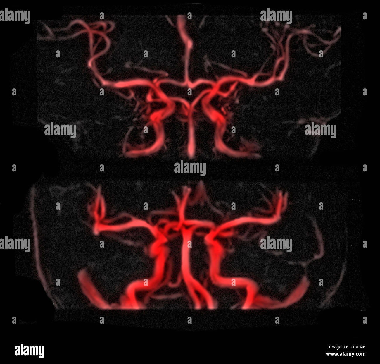 MRI Gehirn vaskulären Röntgenbild, Gadolinium-Kontrast Stockfoto