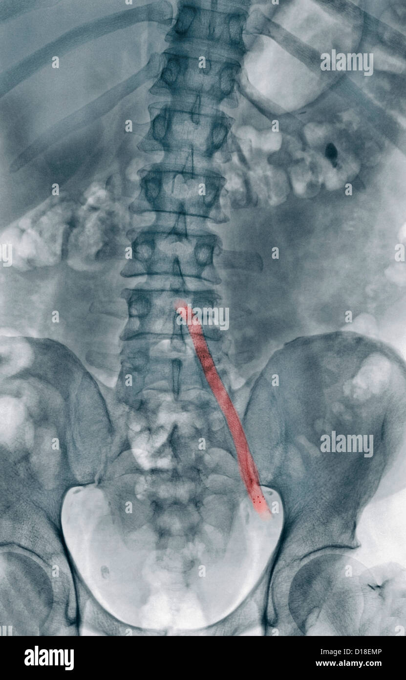 Röntgen, Aorto-Beckenkamm Drahtgeflecht Bypass graft Stockfoto