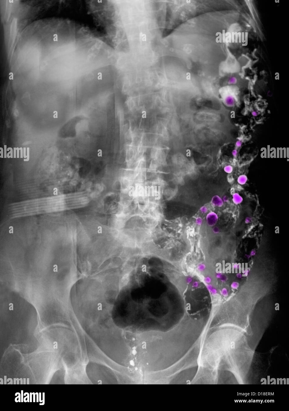X-ray zeigt Divertikulose Stockfoto