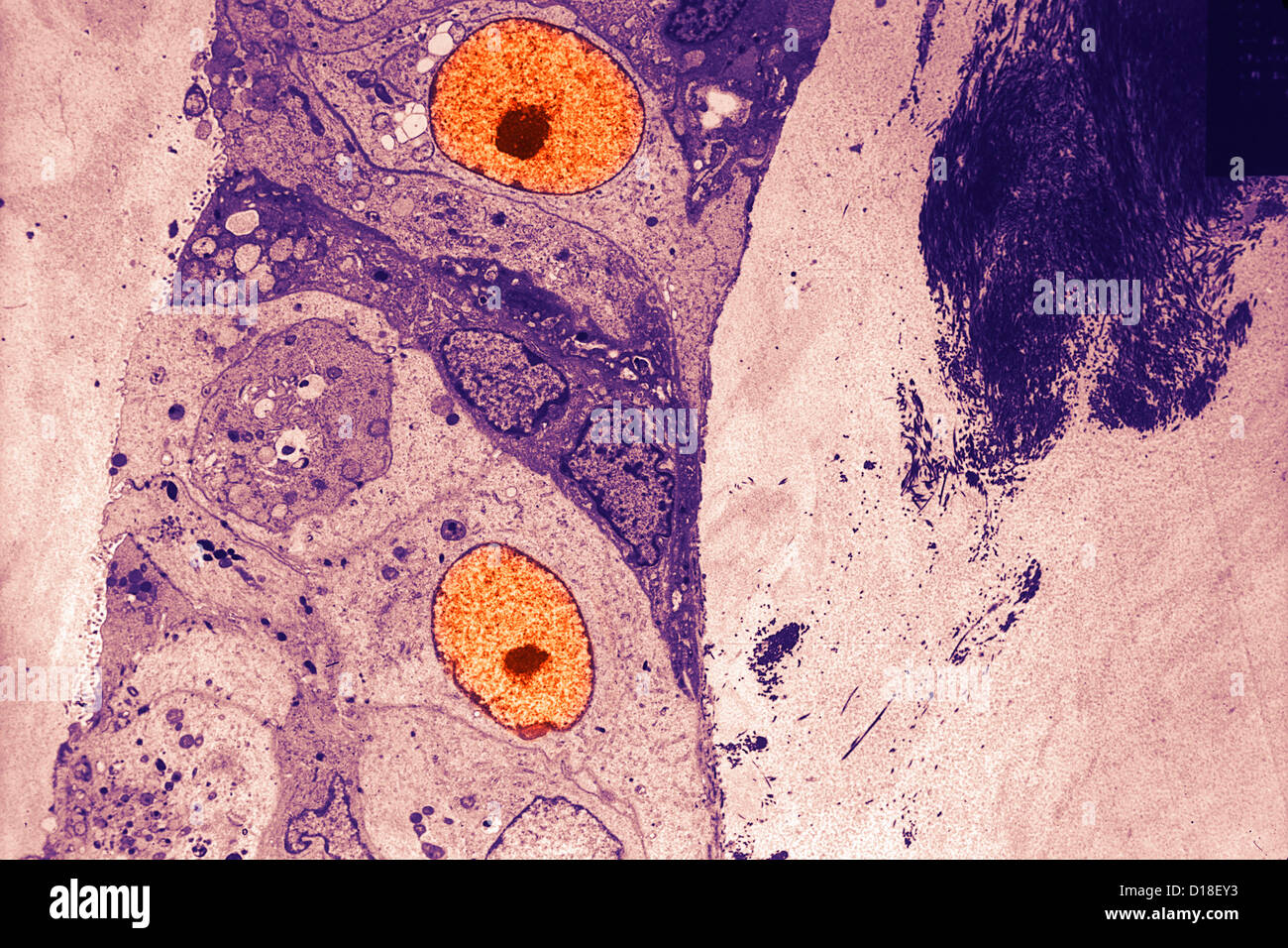 Elektron Schliffbild einer Brust Krebs Zelle Stockfoto