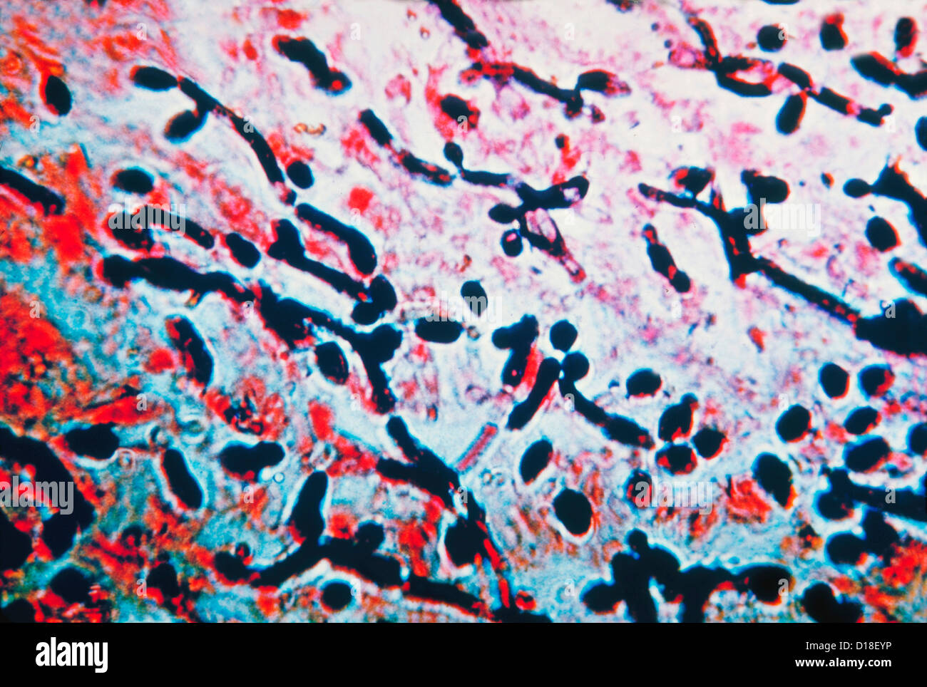 Leichte Aufnahme von Candida im Ösophagus-Schleimhaut Stockfoto