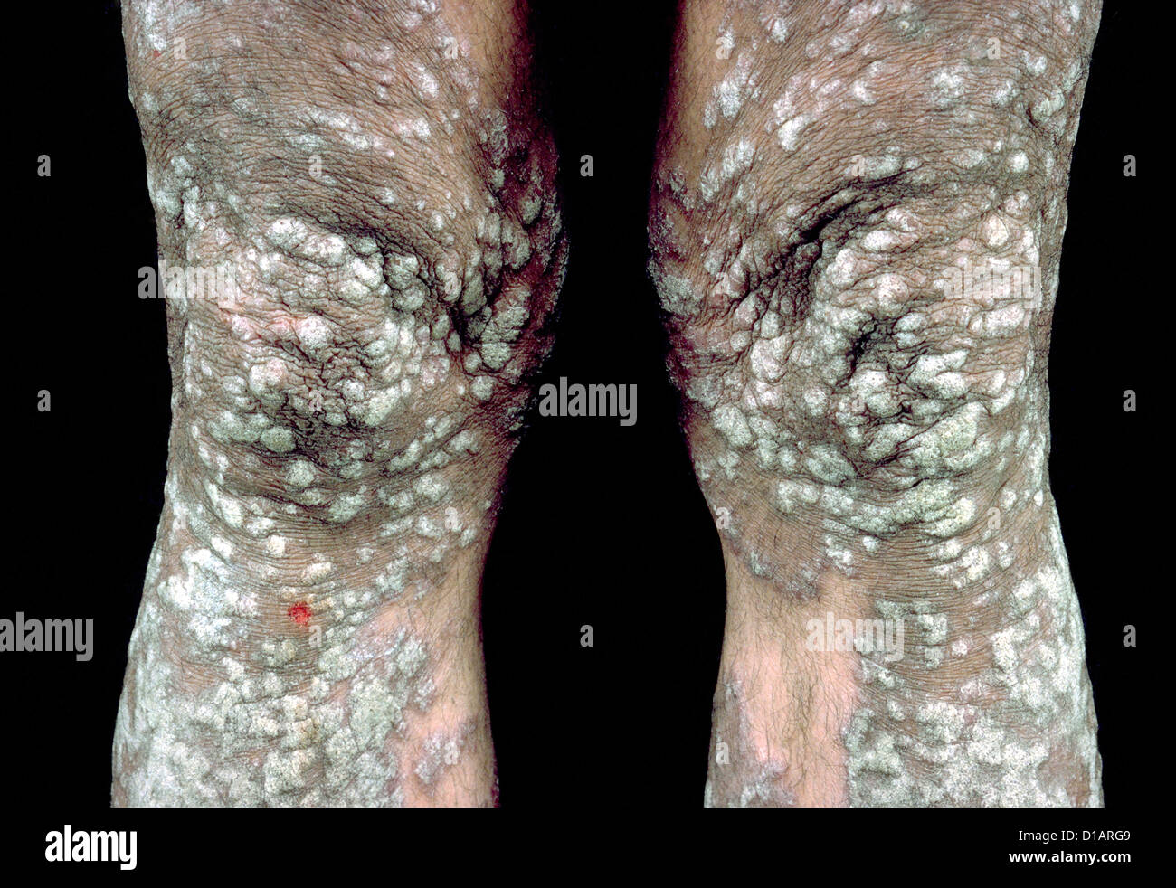 PLAQUE-PSORIASIS Stockfoto