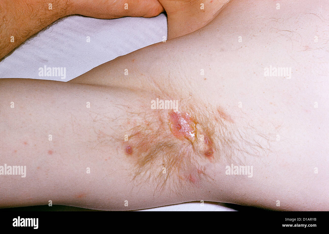 hidradenitis suppurativa bilder hidradenitis suppurativa bilder