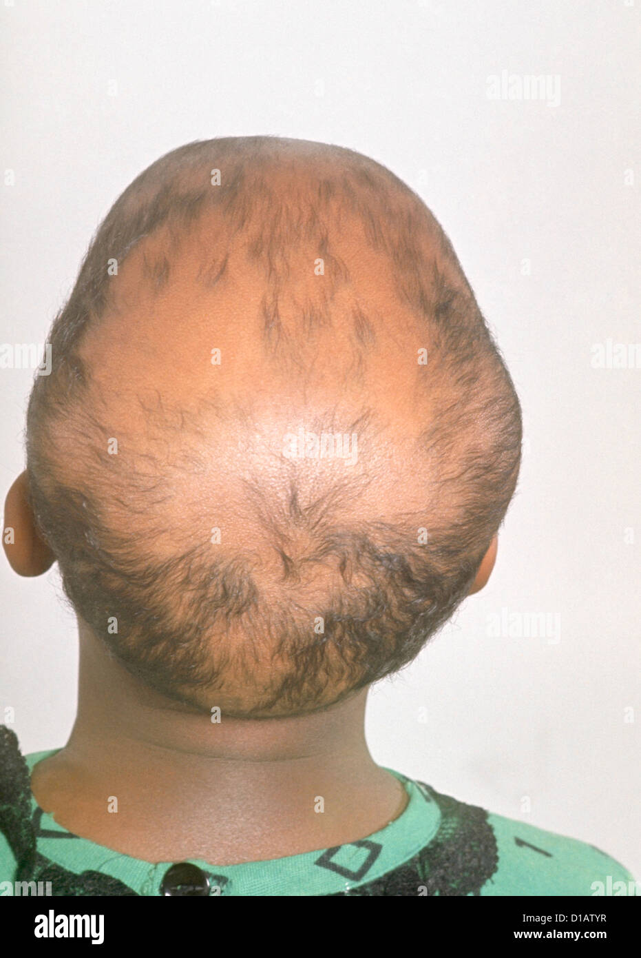 ALOPECIA TOTALIS Stockfoto