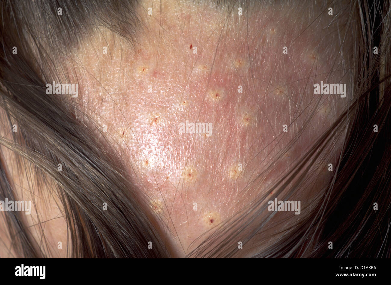 ALOPECIA AREATA Stockfoto