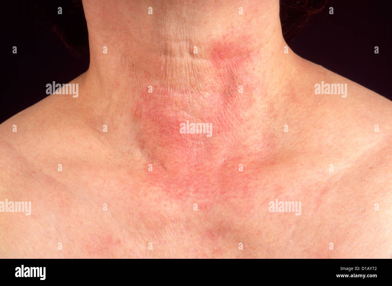 KONTAKTDERMATITIS Stockfoto