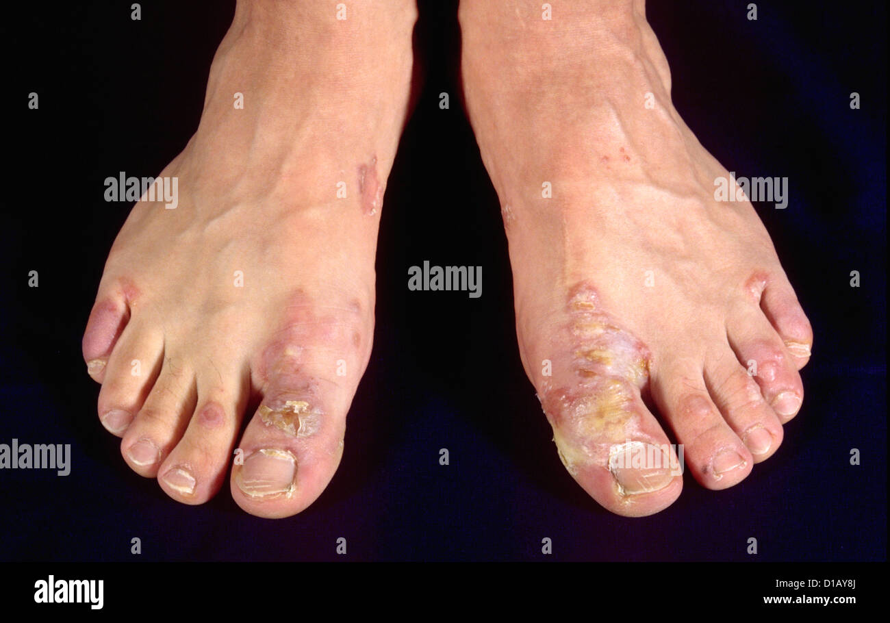 Blisters feet -Fotos und -Bildmaterial in hoher Auflösung - Seite 2 - Alamy