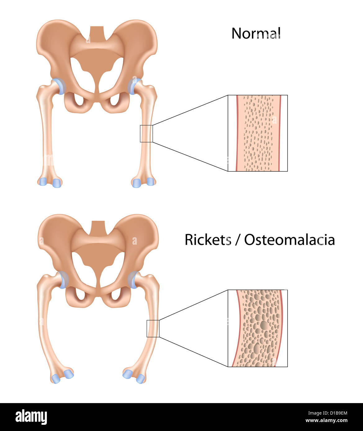 Rachitis und Osteomalazie Stockfoto