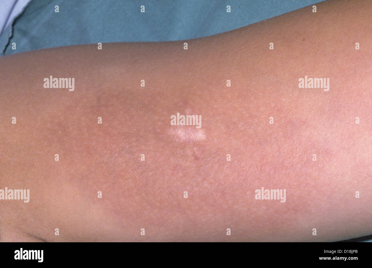 ATROPHODERMA Stockfoto