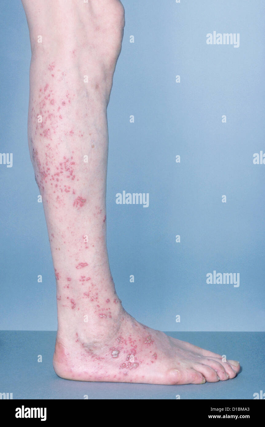 Herpes Zoster Virus Stockfotos &amp; Herpes Zoster Virus Bilder Seite 2