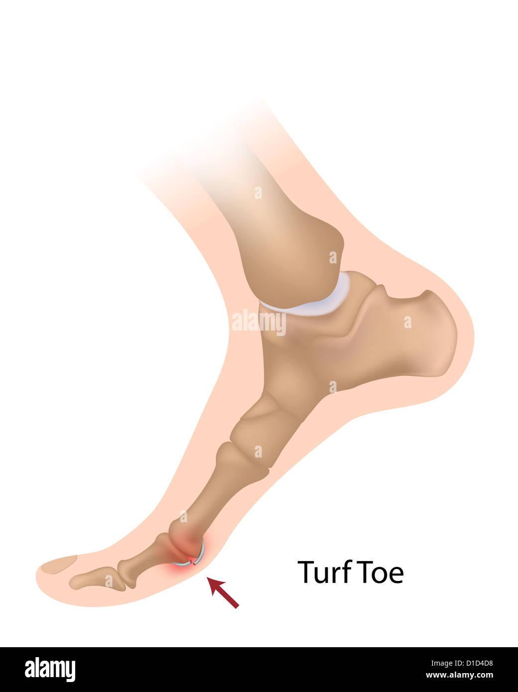 Turf toe Stockfoto