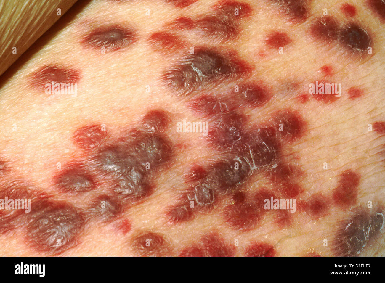 Kaposi-Sarkom auf der Haut eines AIDS-Patienten. Stockfoto
