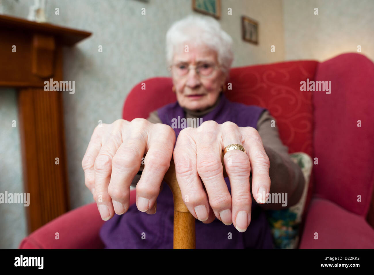 Eine alte Frau mit Arthrose Stockfoto