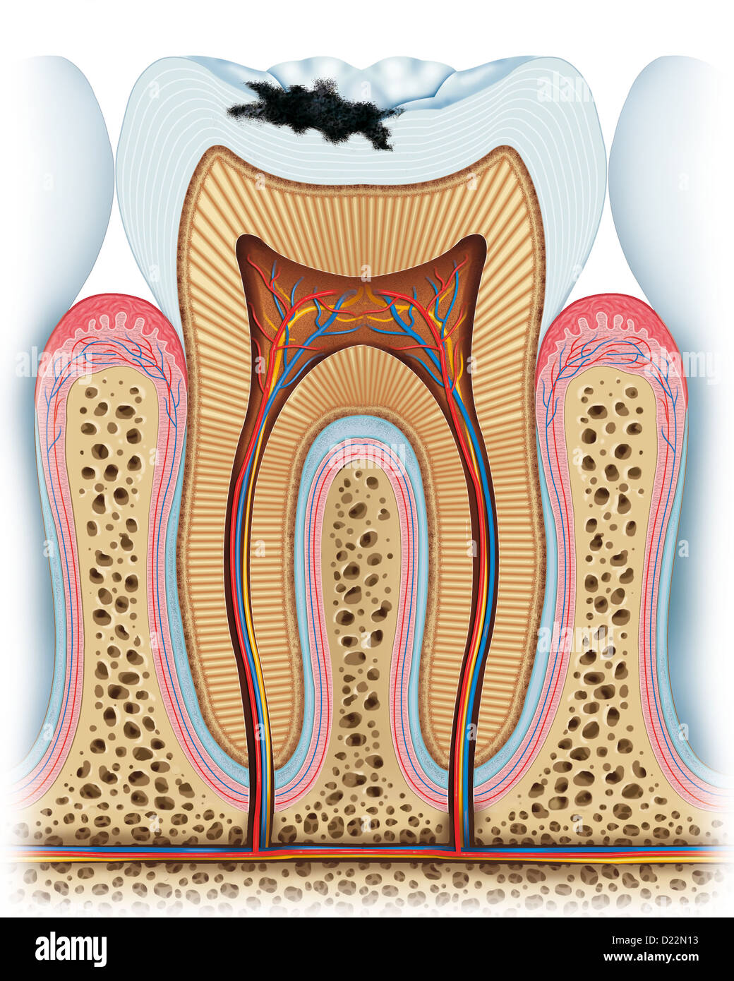 Anatomie eines Zahnes mit dem Prinzip eines Hohlraums Stockfoto