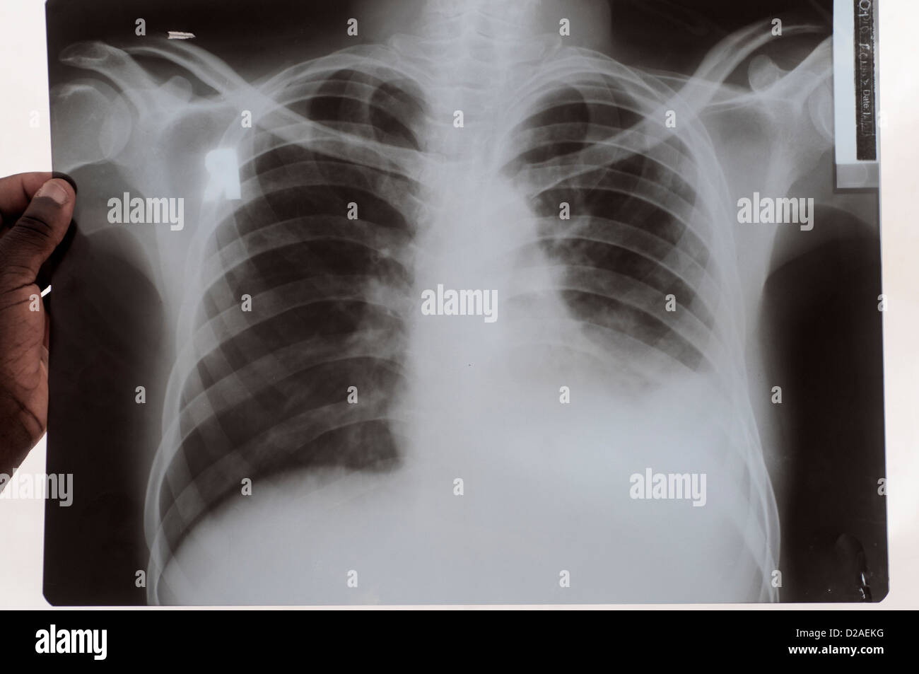 Uganda. Lira. Charis Klinik. X-Ray der TB-Patienten Stockfoto