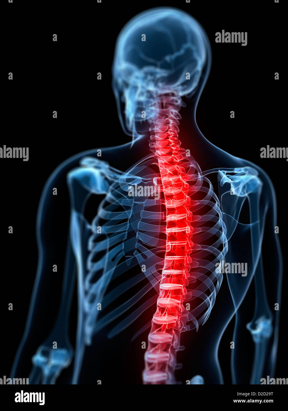 Schmerzen im Rücken konzeptionelle Computer Grafik Stockfoto