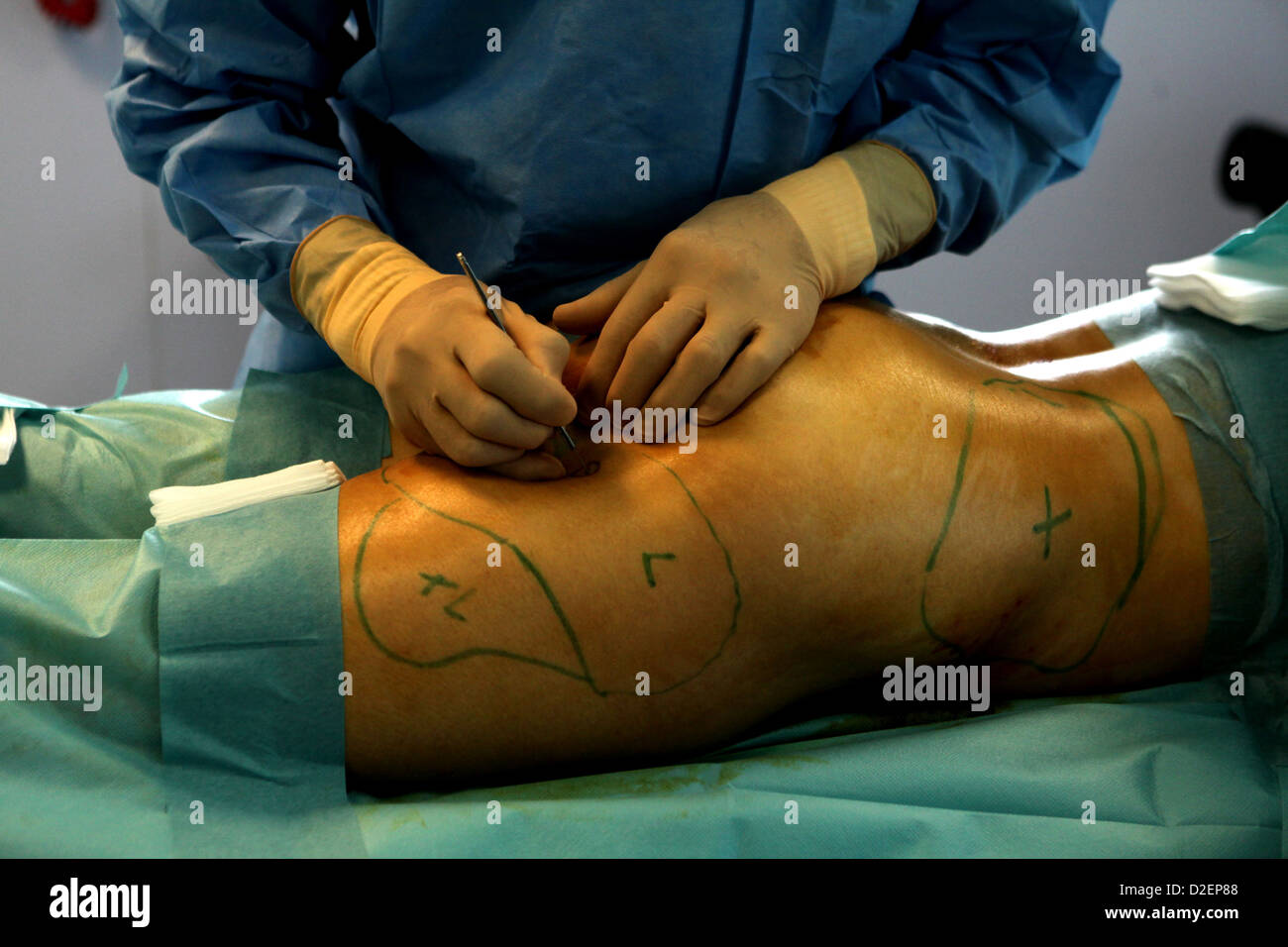 Reportage in der Phenicia kosmetische Chirurgie Klinik in Marseille, Frankreich. Fettabsaugung. Stockfoto