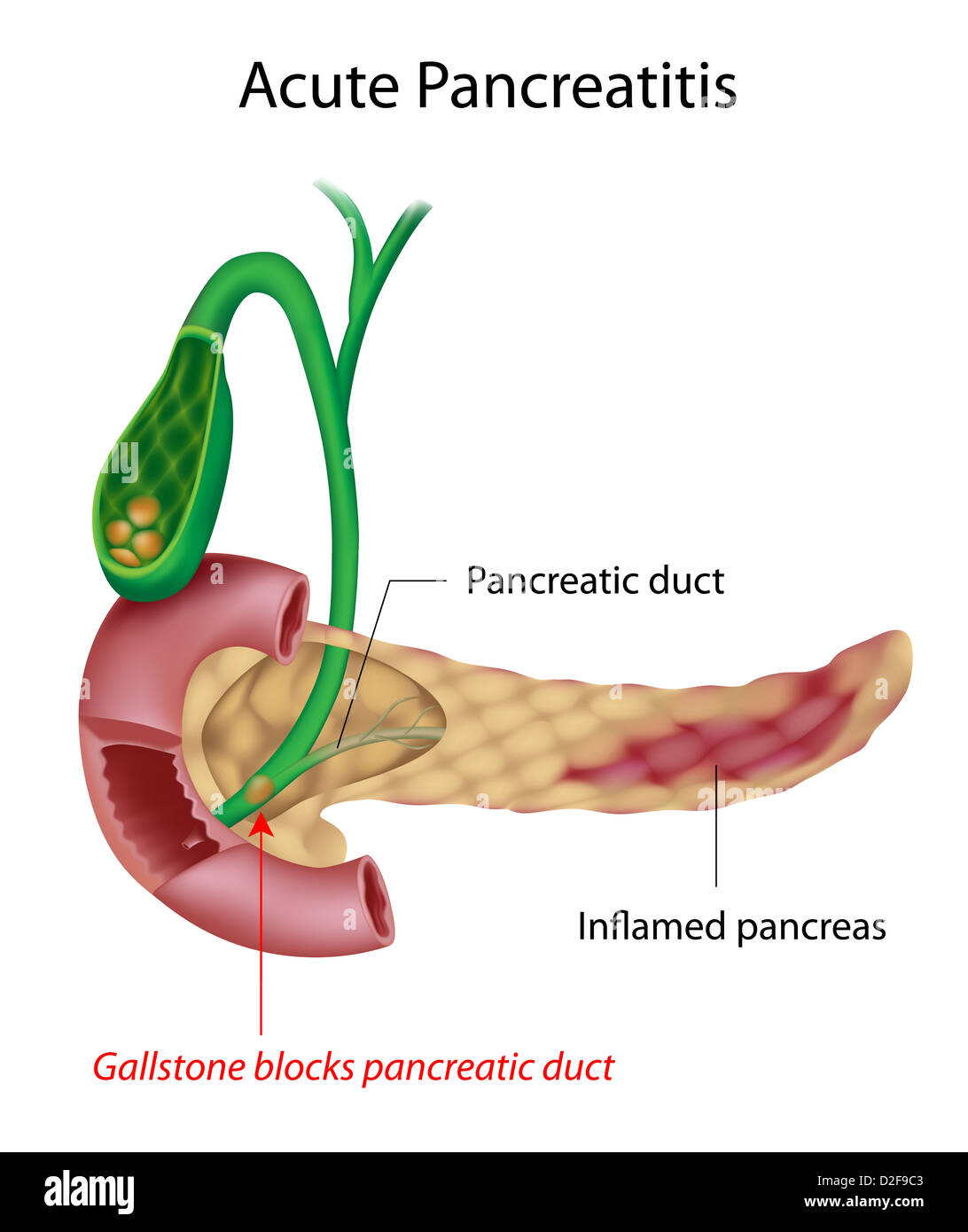 Akute Pankreatitis durch Gallensteine verursacht Stockfoto