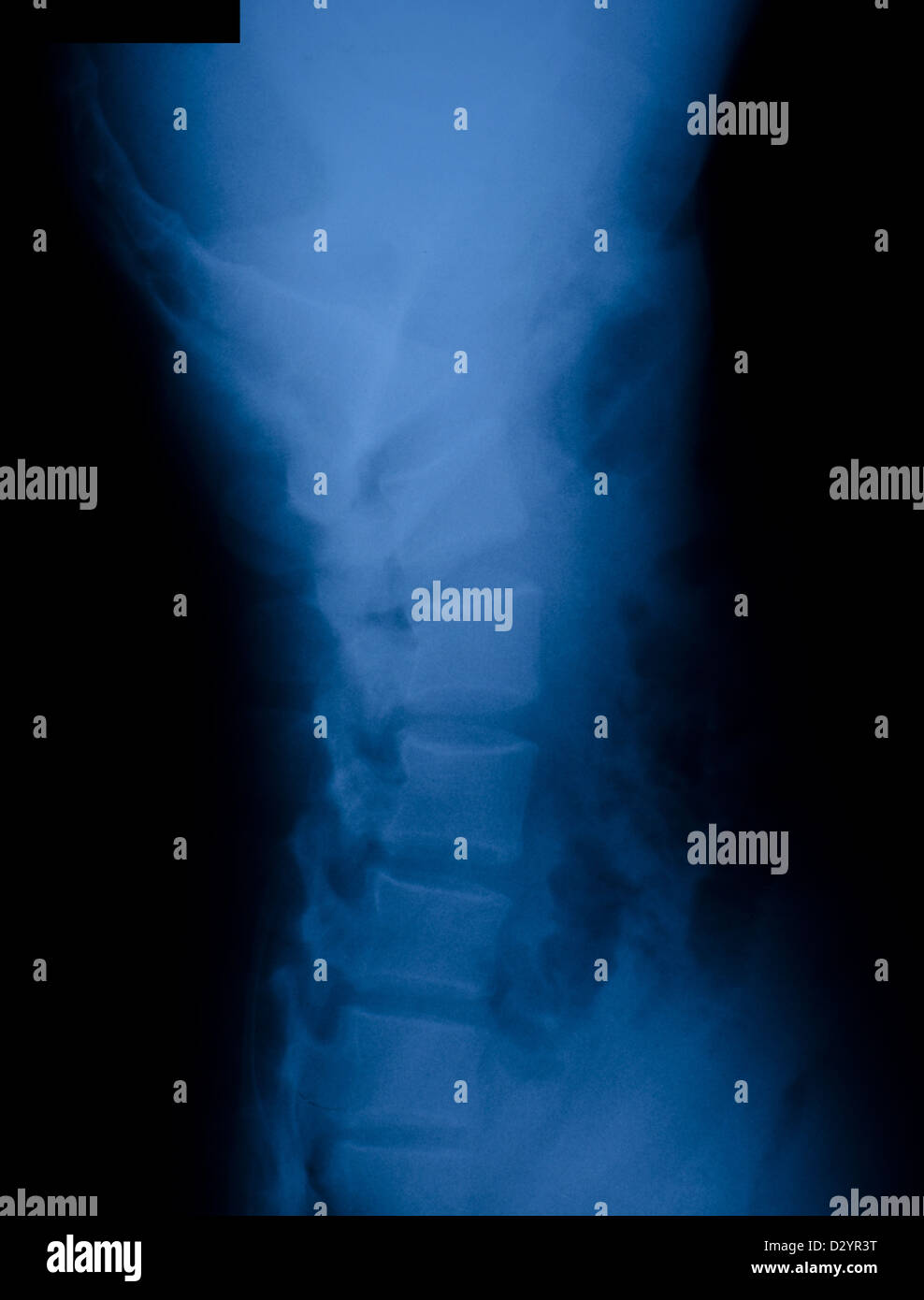 Röntgenfilm der seitlichen Wirbelsäule Stockfoto