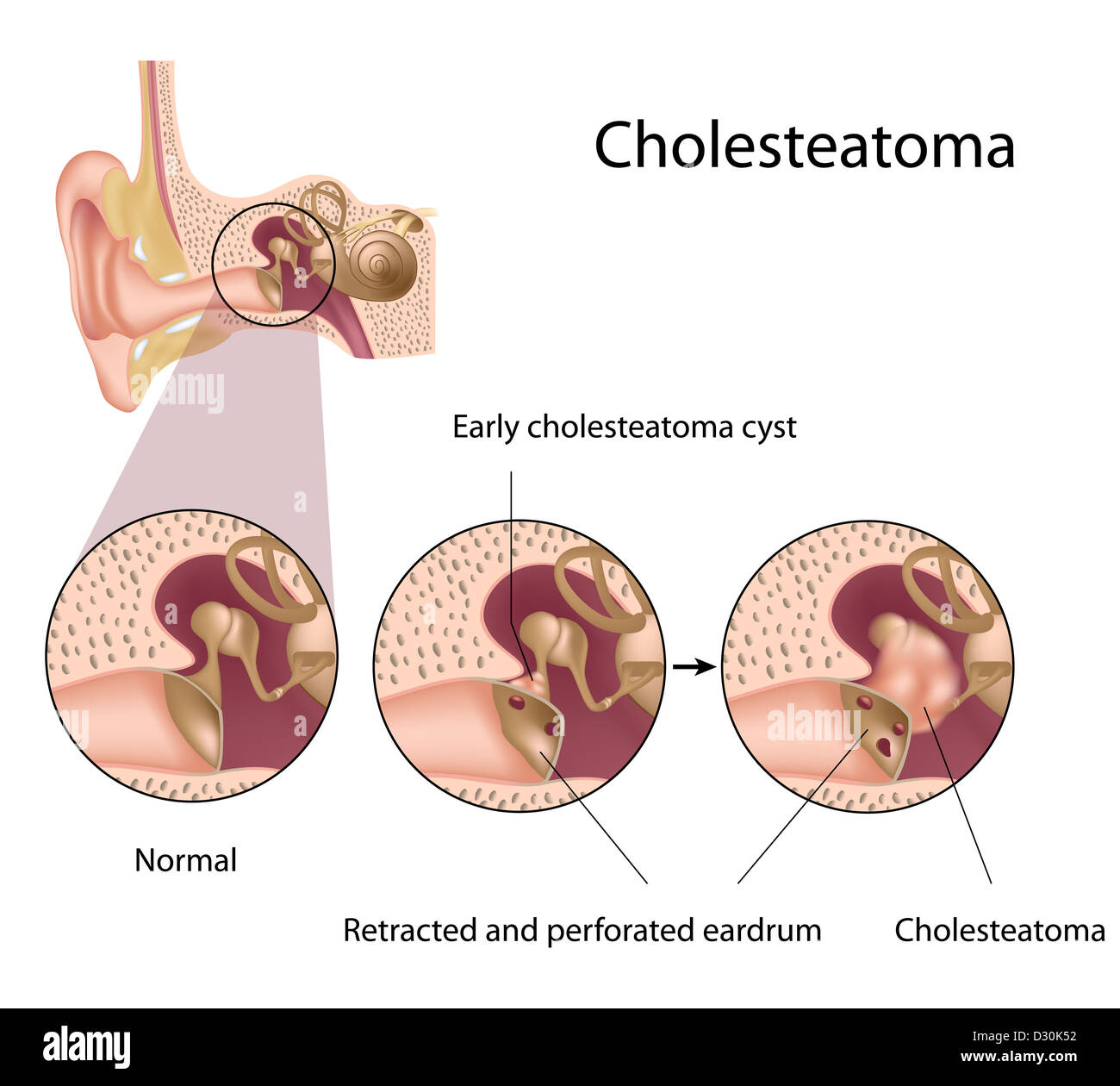 Cholesteatom Stockfoto