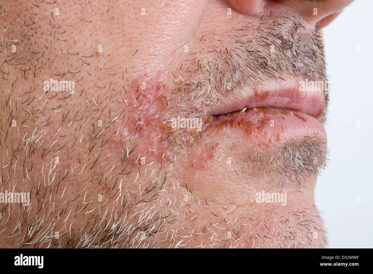 Herpes Simplex Lesions Stockfotos Herpes Simplex Lesions Bilder