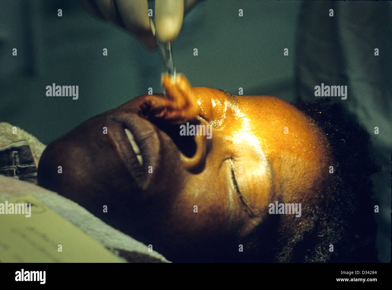 Patienten mit einem Zimbawean Dorf wo die fliegenden Ärzte in flog Cateract Augenoperationen auf Menschen vor Ort durchführen Stockfoto