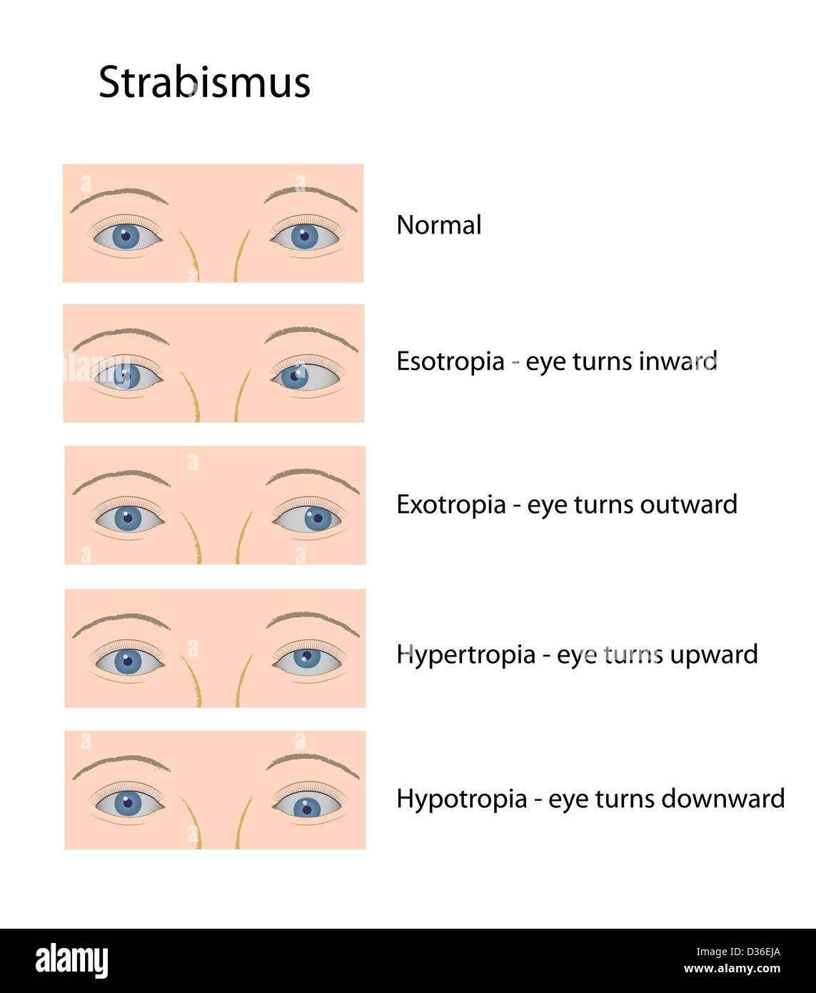 Strabismus Klassifizierung Stockfoto