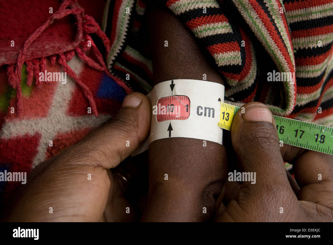 BITENA HEALTH CENTER, Äthiopien, 20. August 2008: ein junges Kind hat den Arm gemessen, um ihr Niveau der Unterernährung zu überprüfen. Stockfoto