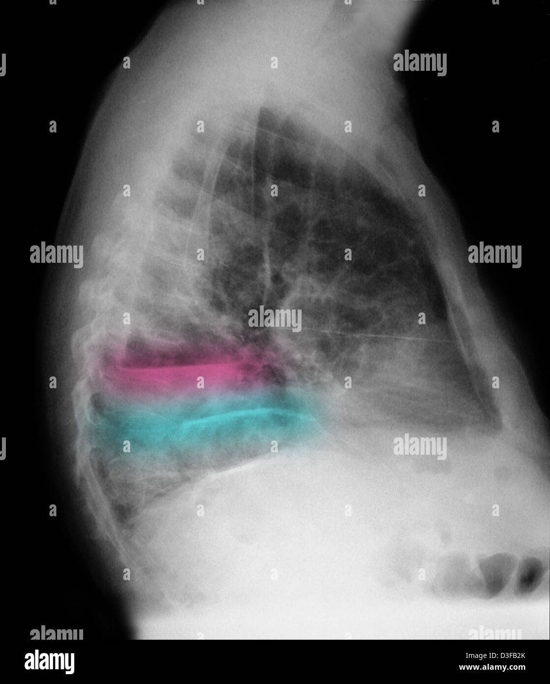 Röntgen-Thorax einer 84 Jahre alten Mannes mit Lungenkrebs Stockfoto