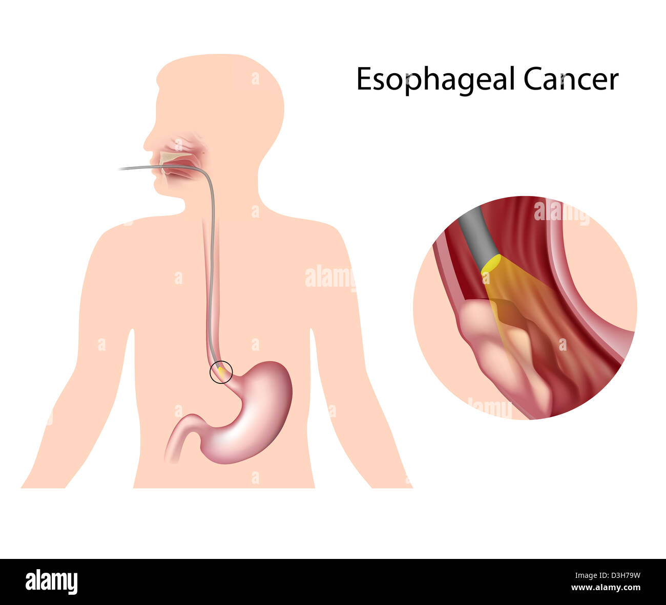 Esophageal Krebs Stockfoto