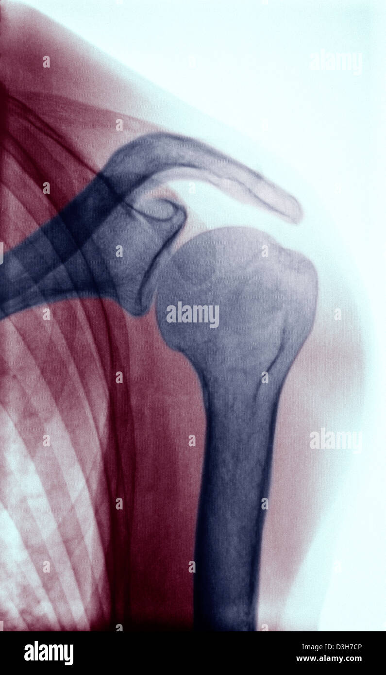 SCHULTER, X-RAY Stockfoto