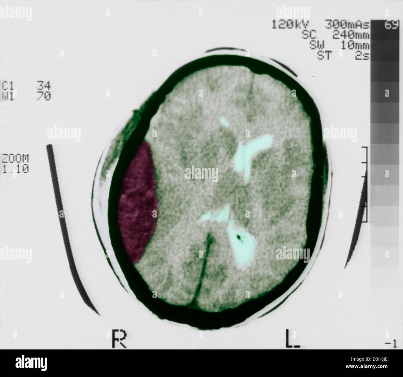HÄMATOM, GEHIRN-SCAN Stockfoto