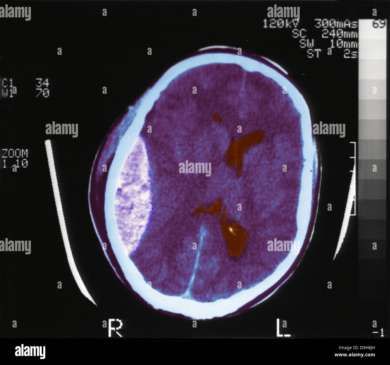 HÄMATOM, GEHIRN-SCAN Stockfoto