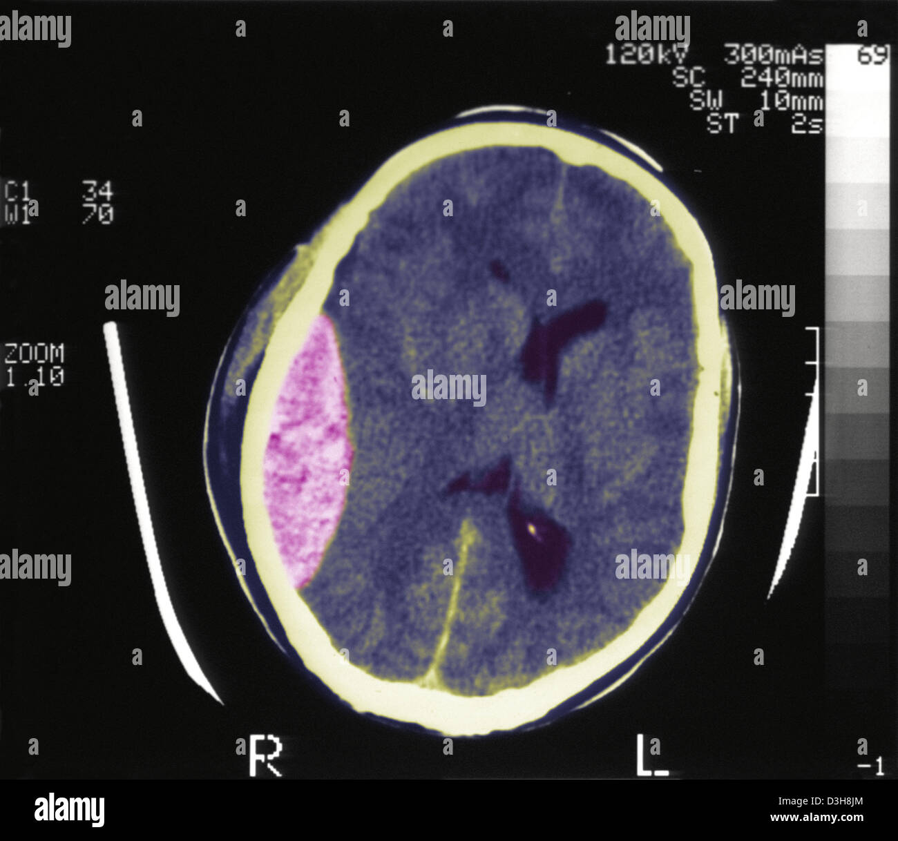 HÄMATOM, GEHIRN-SCAN Stockfoto
