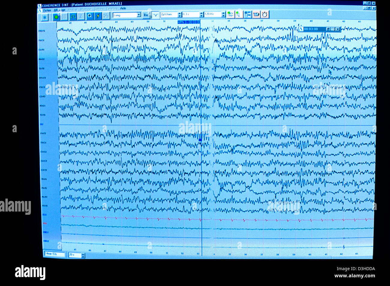 Wie Sieht Ein Eeg Bei Epilepsie Aus www.alamy.de