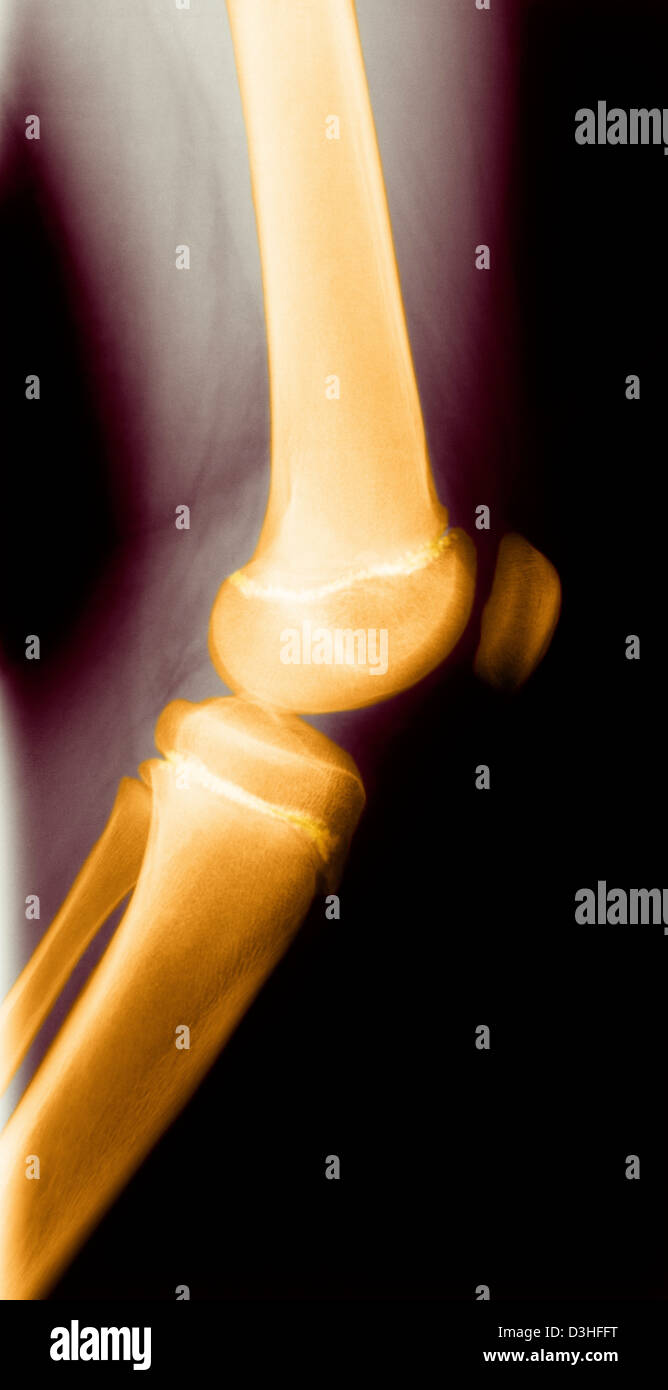 Child knee x ray Fotos und Bildmaterial in hoher Auflösung Alamy