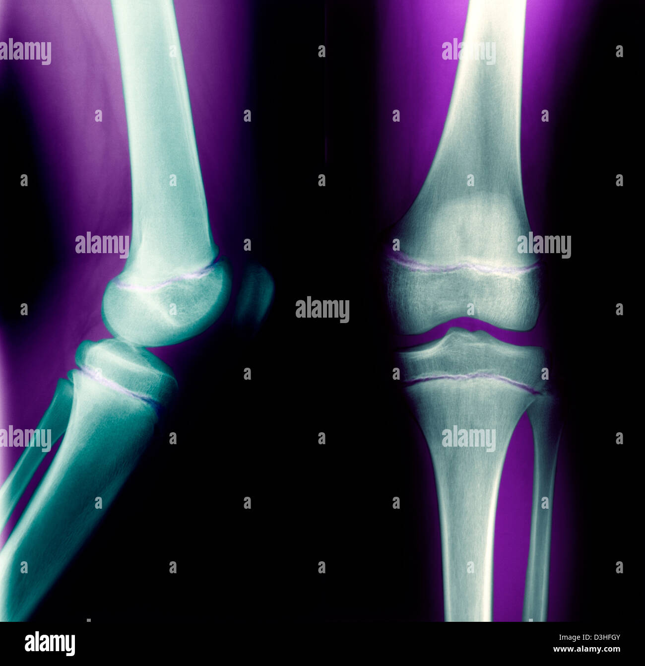 Child knee x ray Fotos und Bildmaterial in hoher Auflösung Alamy