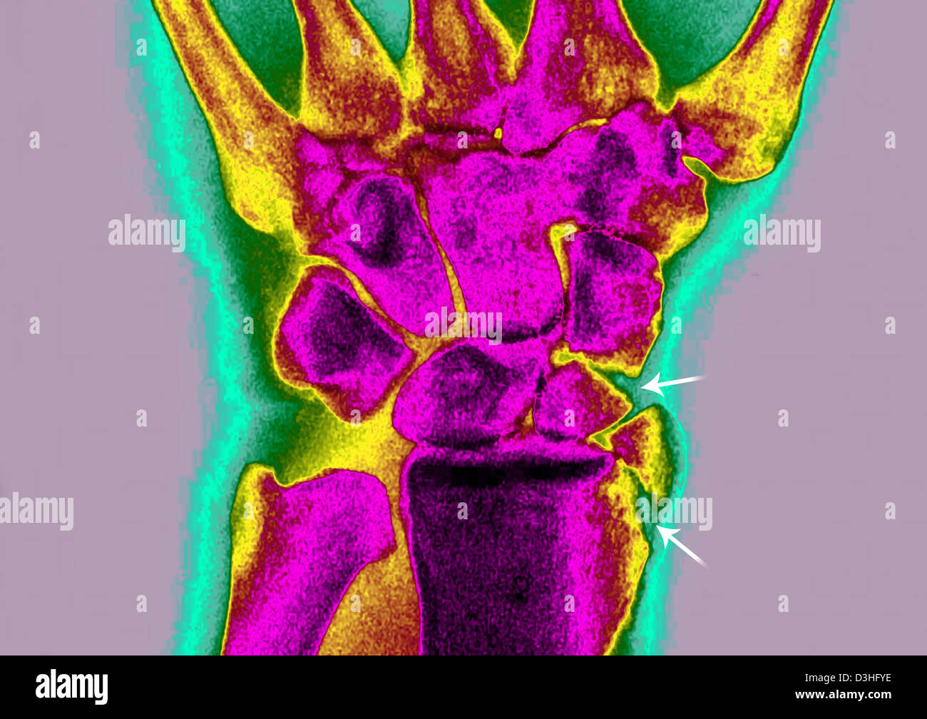 GEBROCHENEN HANDGELENK, X-RAY Stockfoto