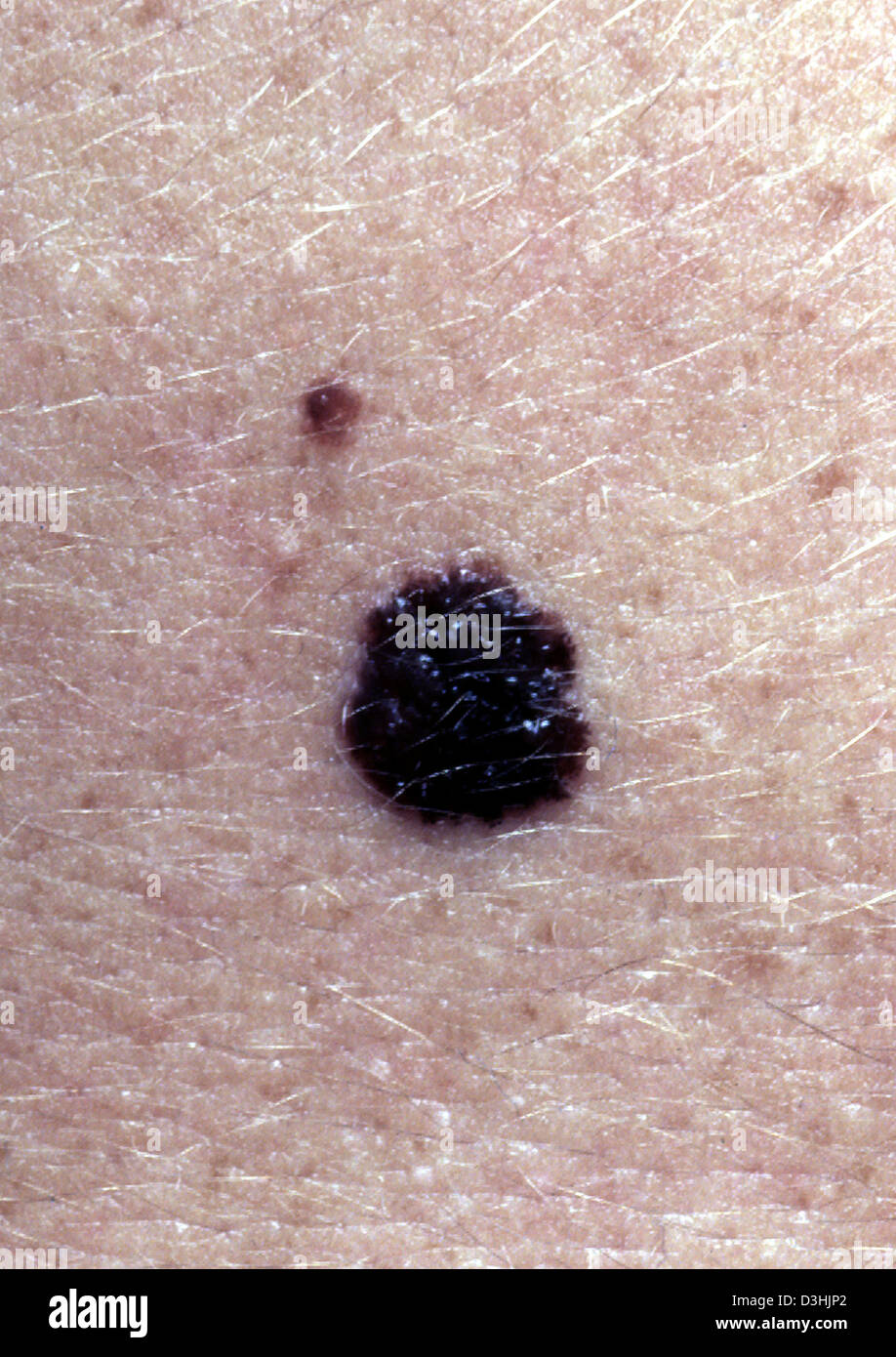 MALIGNES MELANOM Stockfotografie - Alamy