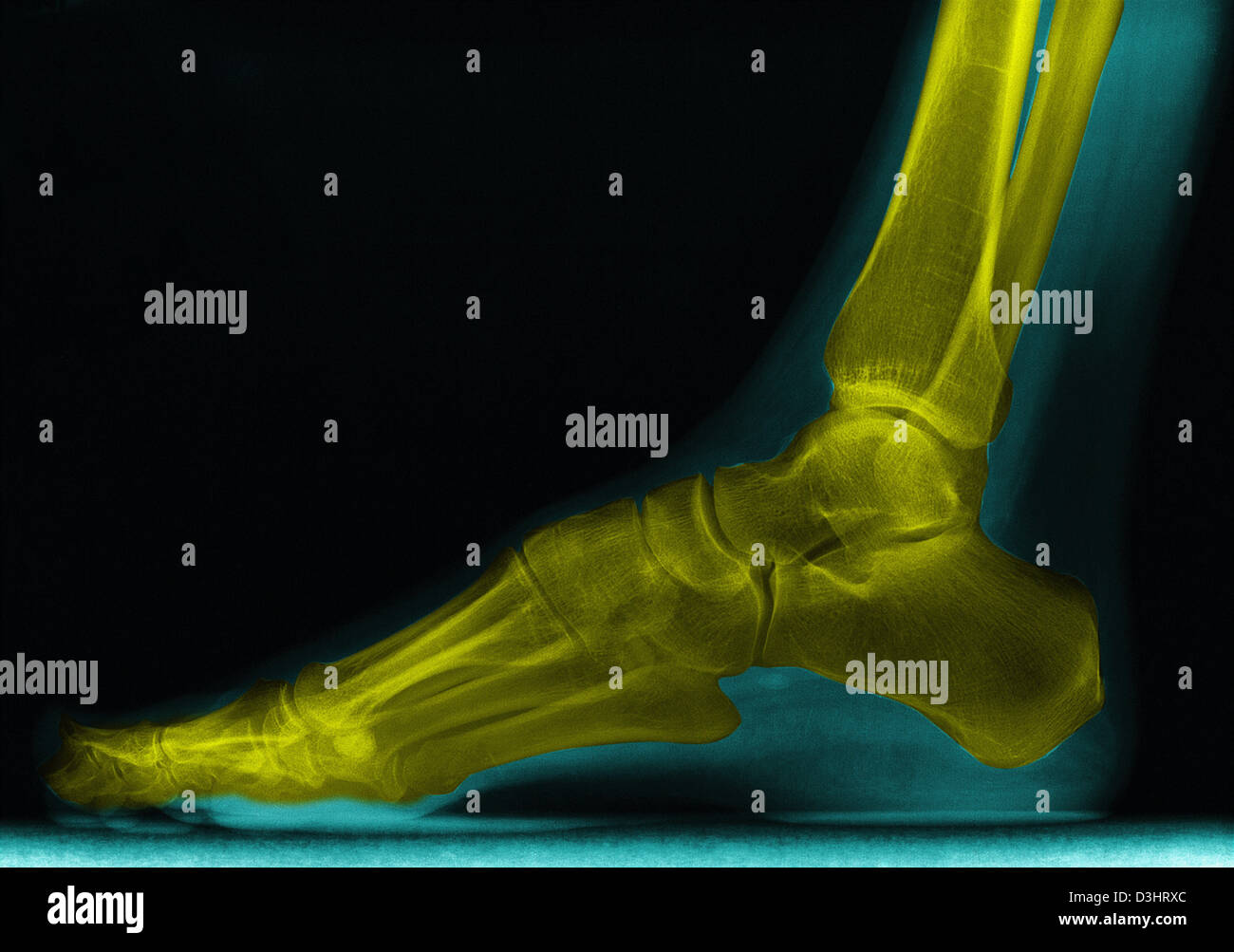 Foot xray -Fotos und -Bildmaterial in hoher Auflösung – Alamy